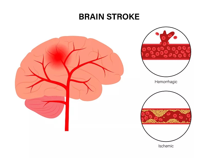 間充質干細胞治療缺血性腦卒中之前應該了解哪些問題