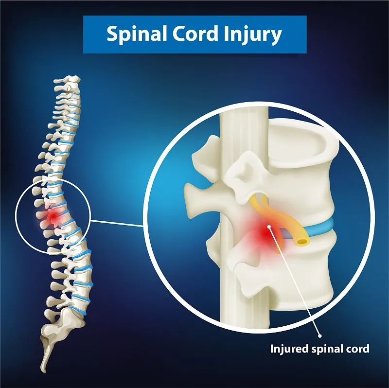 脊髓損傷的癥狀及原因丨如何管理和治療