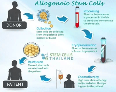 同種異體干細(xì)胞移植流程