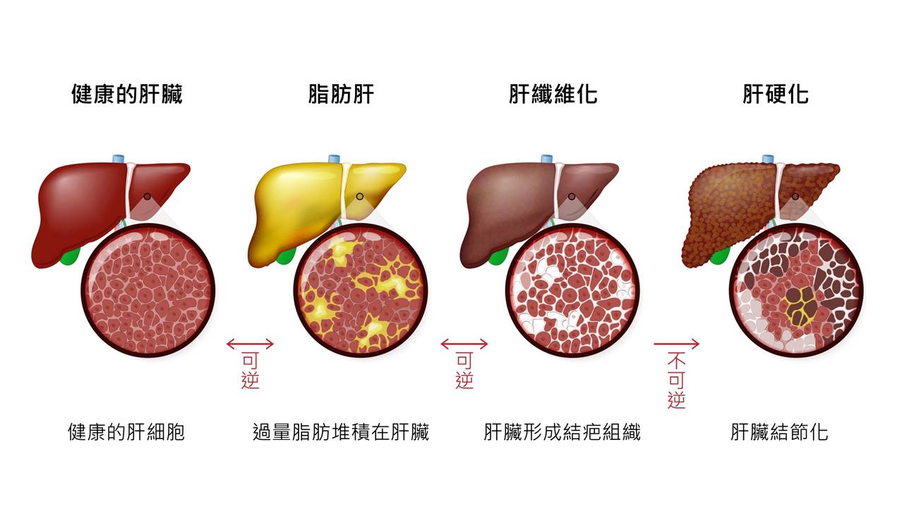 肝臟疾病進(jìn)展