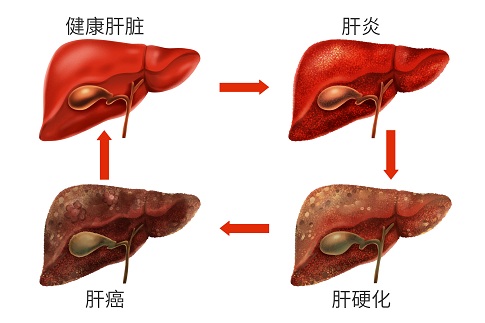 人臍帶血間充質(zhì)干細(xì)胞移植治療失代償性肝硬化患者