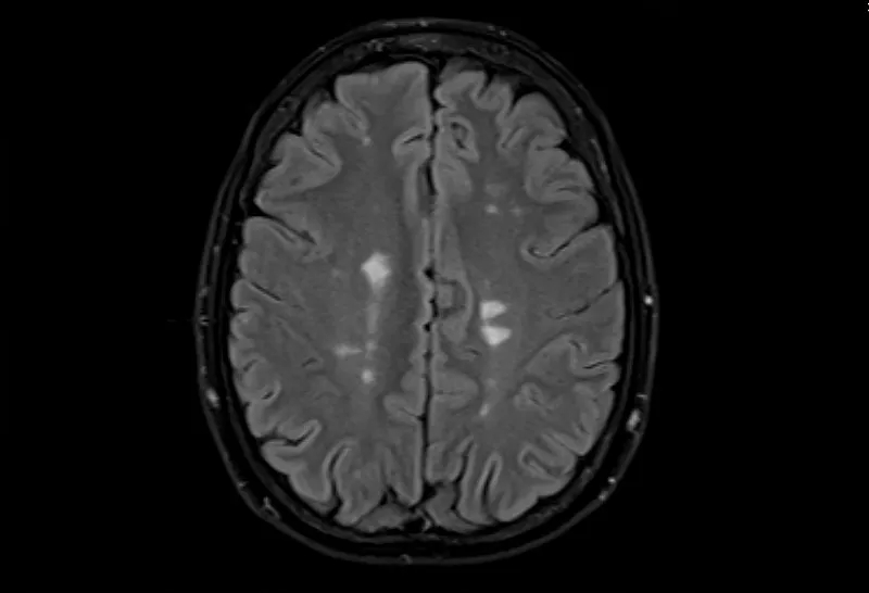 多發(fā)性腦硬化癥的磁共振成像，軸位Flair視圖