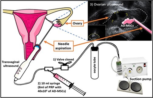 圖1：PRP+AD-MSCs在卵巢中的應(yīng)用；