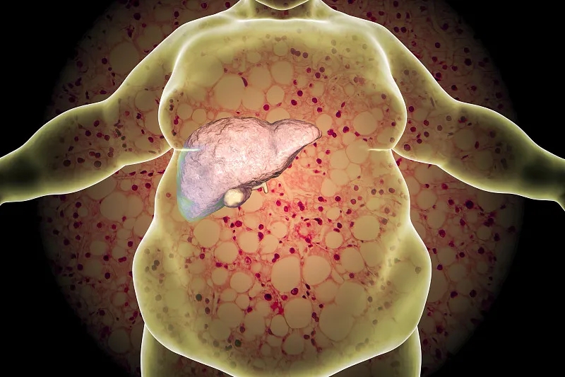 什么是非酒精性脂肪肝（NAFLD）