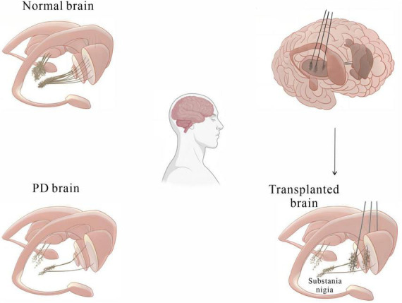 圖2：基本圖顯示細胞移植療法如何緩解帕金森病患者的運動癥狀。
