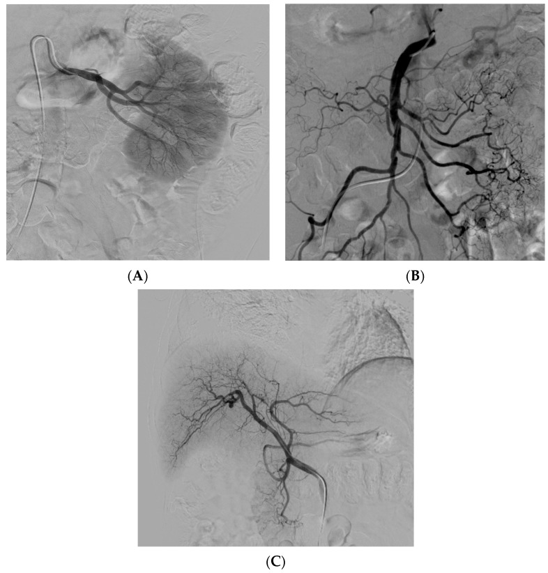 圖2：腎 (?A?)、腸系膜上動脈 (?B?) 和肝動脈 (?C?) 的血管造影插管
