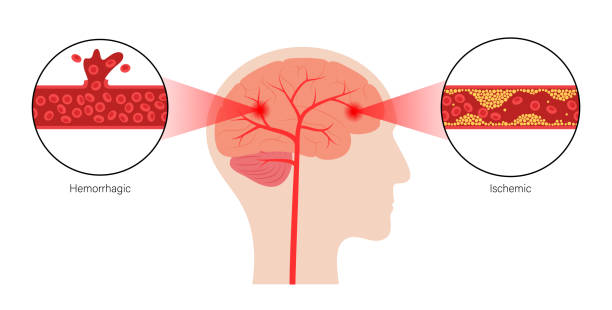 缺血性腦卒中