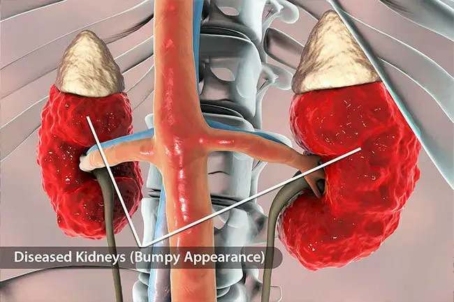 慢性腎病 (CKD)