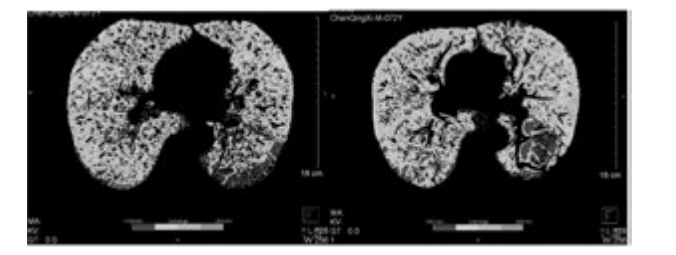 雙源CT肺實(shí)質(zhì)分析軟件