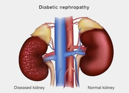 糖尿病腎病如何治療？干細(xì)胞療法為什么讓糖尿病腎病患者驚嘆？