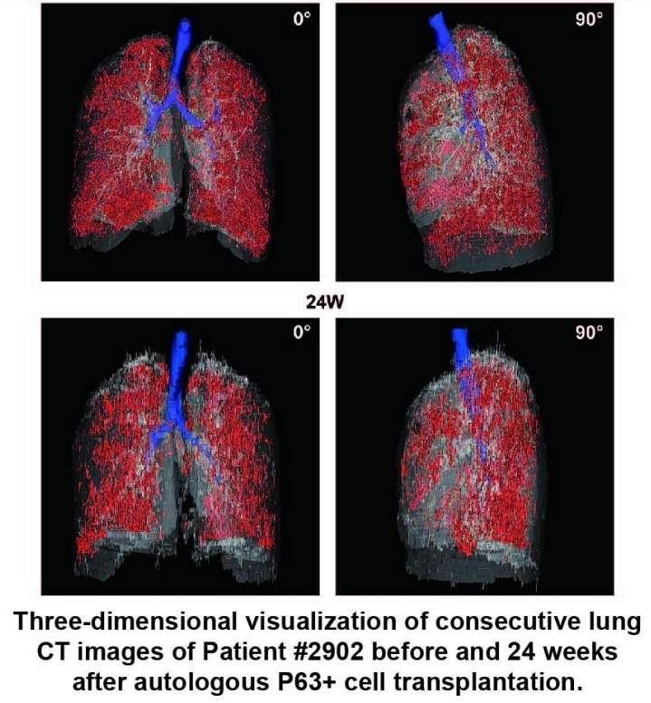 患者#2902在自體P63+細(xì)胞移植前后24周連續(xù)肺部CT圖像的三維可視化。