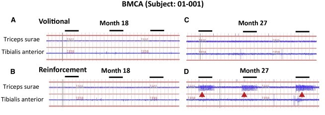 圖2：患者1腦運動控制評估(BMCA)和EMG評估