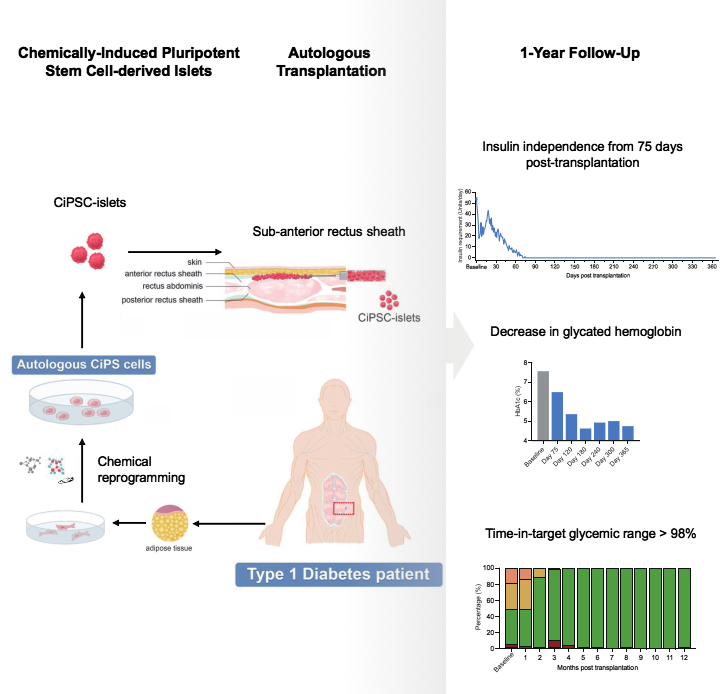基于CiPS細(xì)胞治療1型糖尿病的臨床研究的示意圖和治療效果