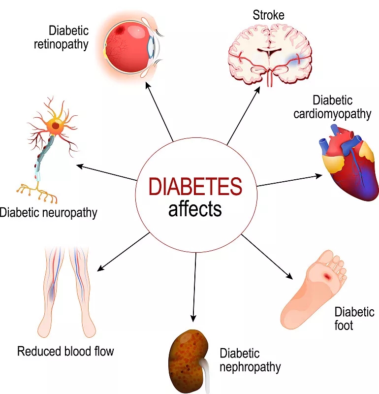 糖尿病影響糖尿病的并發(fā)癥