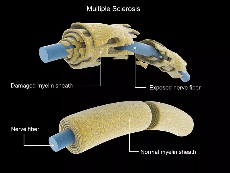 多發(fā)性硬化癥神經元與正常神經元的比較