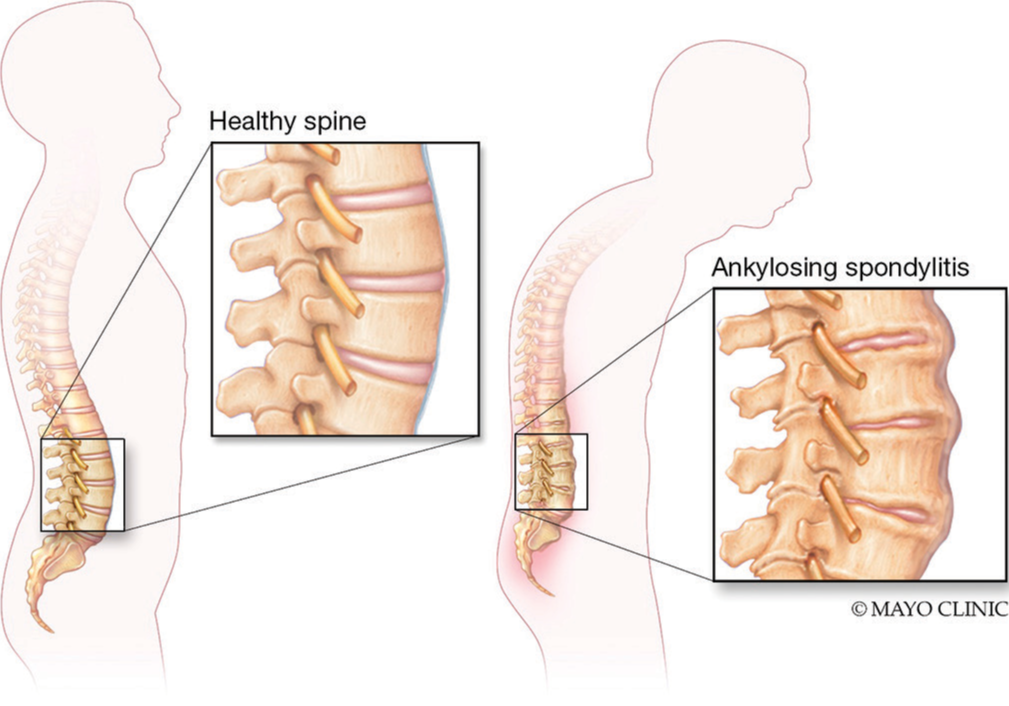 強直性脊柱炎的類型和階段