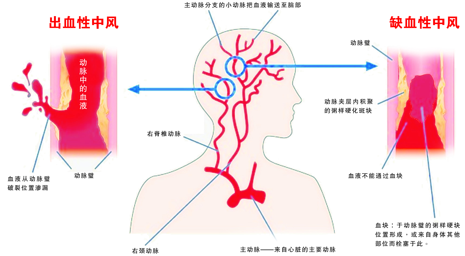 干細胞治療腦卒中的臨床試驗研究進展