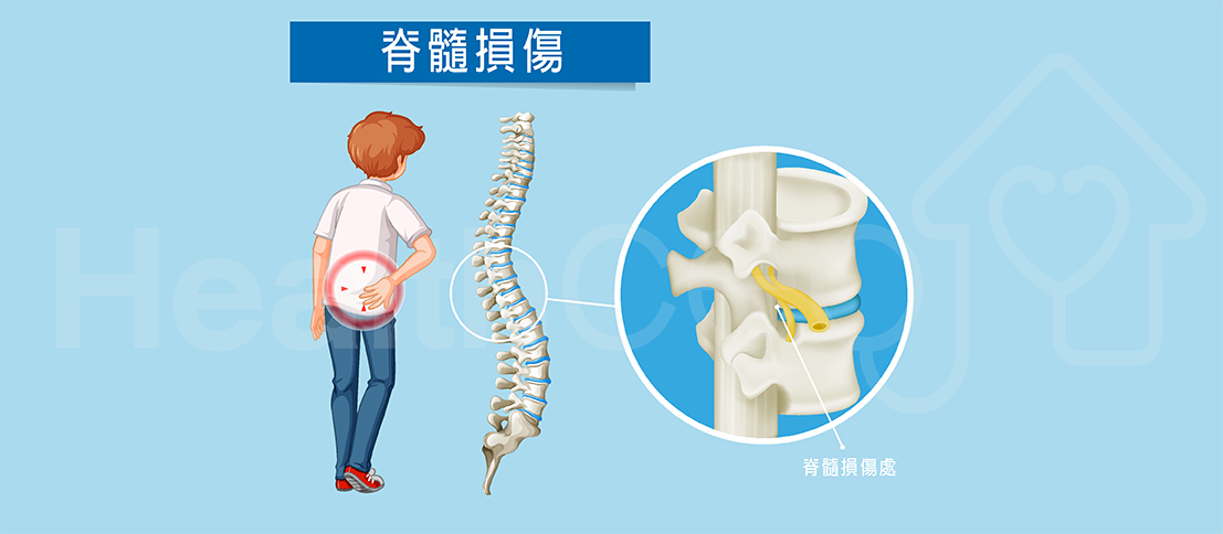 不同類型不完全性脊髓損傷的最佳治療方法