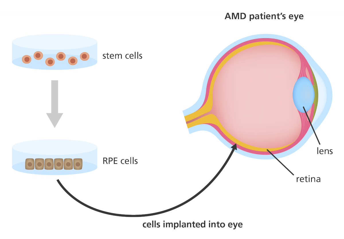 插圖顯示干細(xì)胞如何用于產(chǎn)生可用于治療年齡相關(guān)性黃斑變性 (AMD) 患者的視網(wǎng)膜色素上皮 (RPE) 細(xì)胞