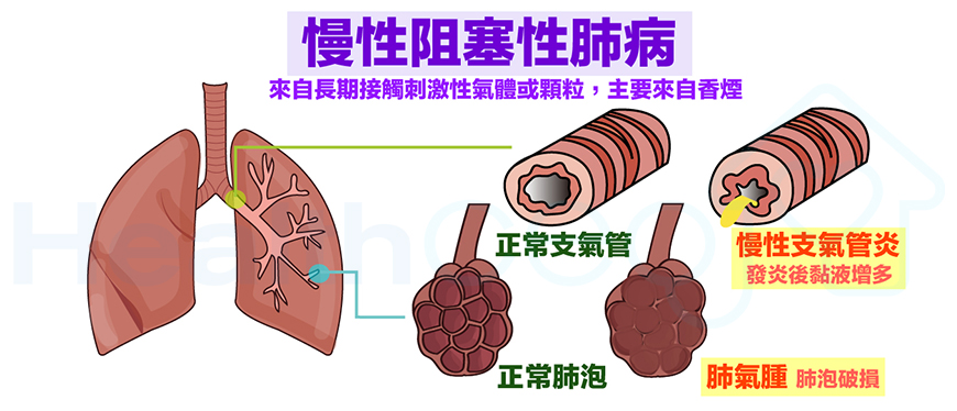 使用干細胞治療慢性阻塞性肺病的一例病例