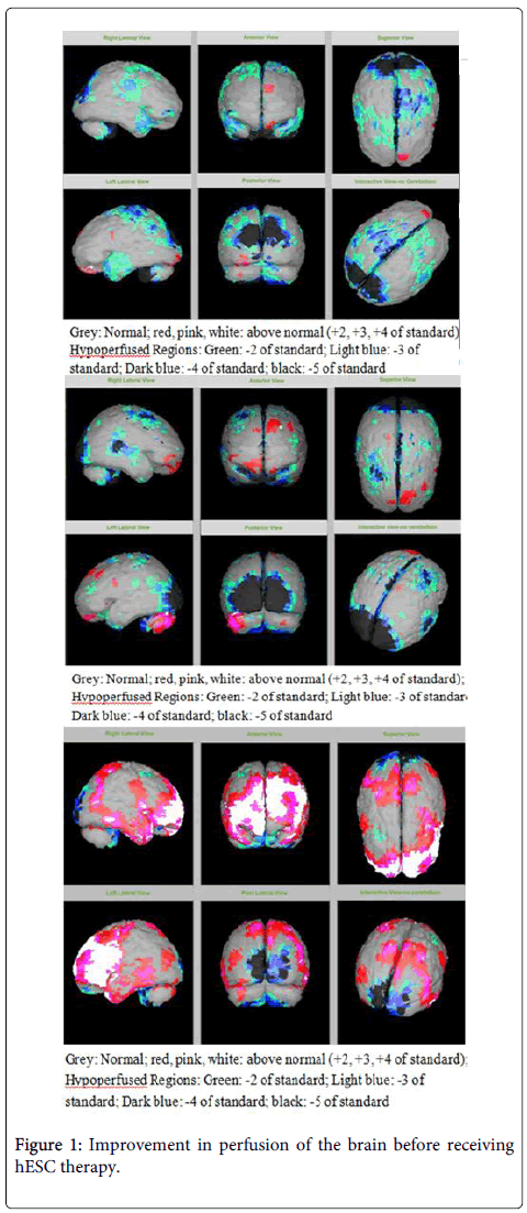圖1：接受hESC治療前大腦灌注的改善。
