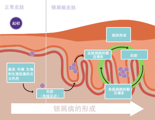 銀屑病治愈：是科學(xué)事實(shí)還是虛假希望？