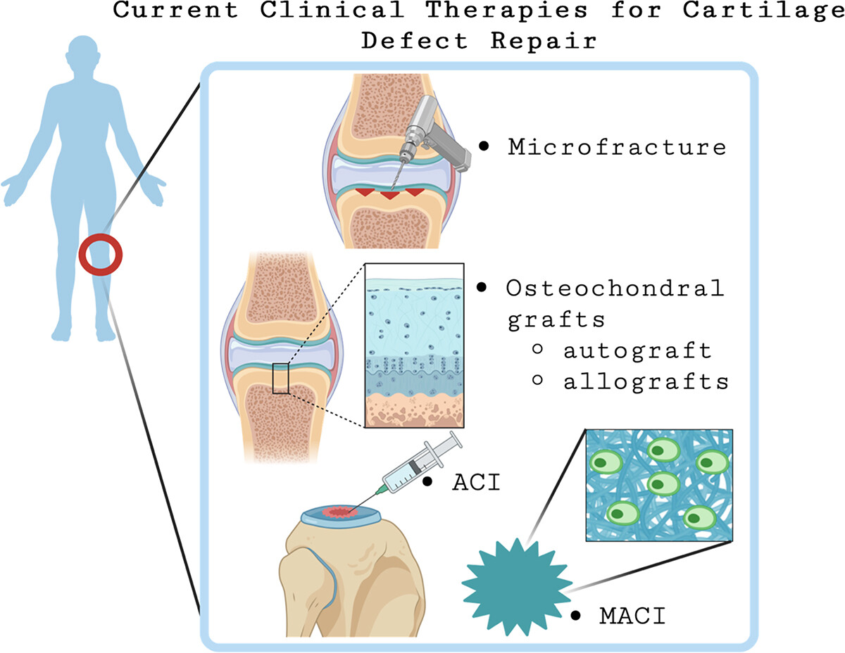 圖1：FDA批準(zhǔn)并實(shí)施的軟骨缺損再生療法示意圖總結(jié)