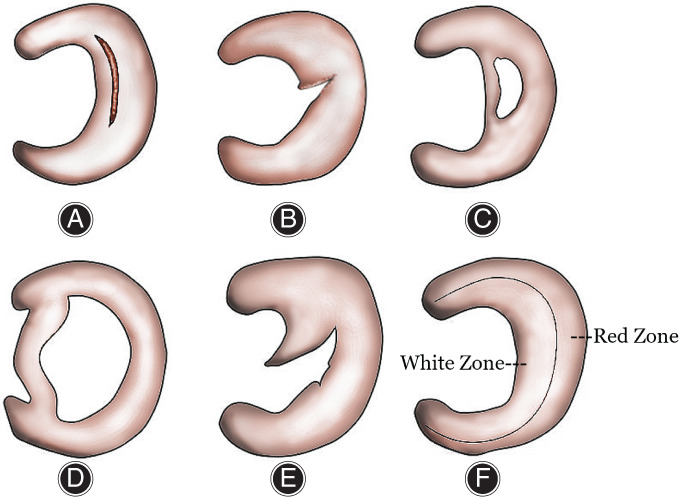 圖2：半月板的解剖結構和損傷類型