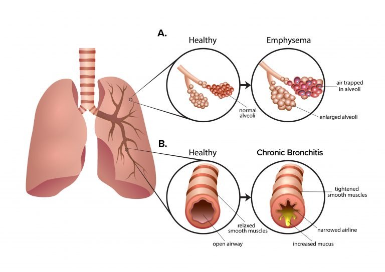 圖2：慢性阻塞性肺疾病 (COPD) 是一組導致呼吸困難的肺部疾病。A.肺氣腫導致肺泡氣囊受損和僵硬?？諝獗焕г诜闻葜?，導致呼氣困難。B.慢性支氣管炎會導致氣道腫脹和粘液增多。多余的粘液使呼吸困難并導致慢性咳嗽