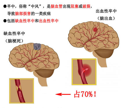 干細(xì)胞治療缺血性腦卒中的新進(jìn)展：2/3期臨床試驗(yàn)結(jié)果揭曉