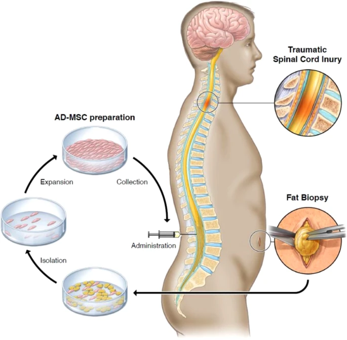 通過活檢、AD-MSC 分離、擴(kuò)增和收集以及治療管理來獲取脂肪的過程圖解