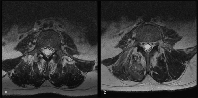 6號(hào)患者腰椎T2加權(quán)磁共振成像 (MRI) 的軸向視圖，該患者在L4-S1輸注后出現(xiàn)馬尾夾緊。L4水平的輸注前 MRI 掃描。b1年隨訪時(shí)L4水平的輸注后 MRI掃描。