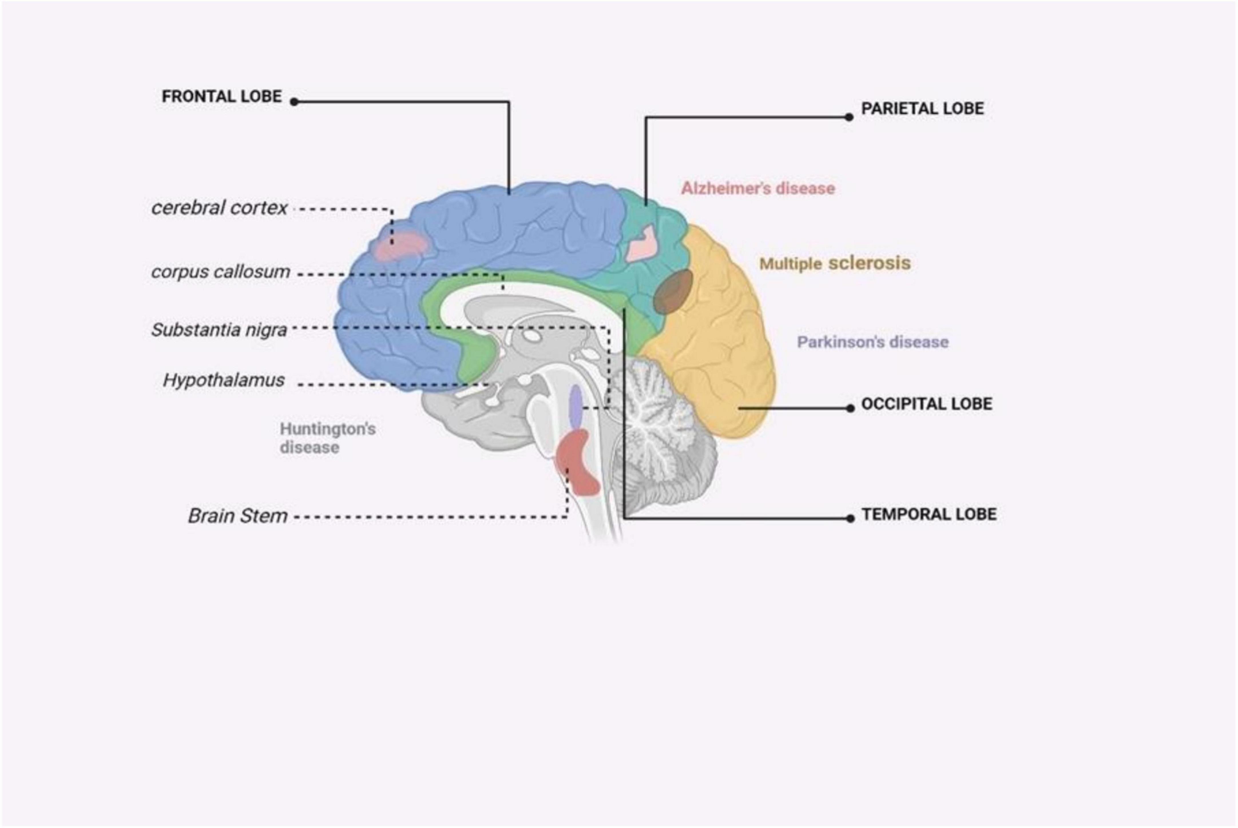 圖4：受主要神經(jīng)退行性疾病影響的大腦區(qū)域的圖解摘要