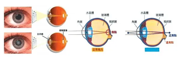 干細(xì)胞治療兒童白內(nèi)障臨床案例