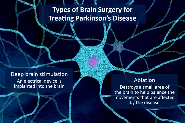 帕金森病的腦部手術：類型、恢復和風險