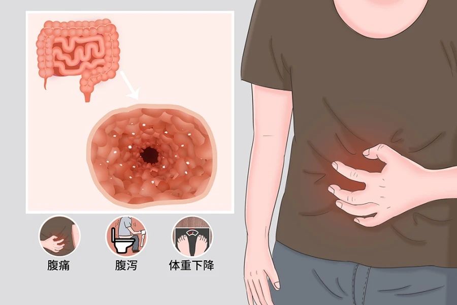 中山大學(xué)醫(yī)院：8例克羅恩病患者在干細(xì)胞治療后，臨床癥狀和體征顯著改善